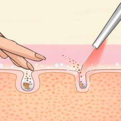 LUMINEO Professional Line Peeling kawitacyjny LED 5w1 + Tonik nawilżający do kawitacji Lumineo